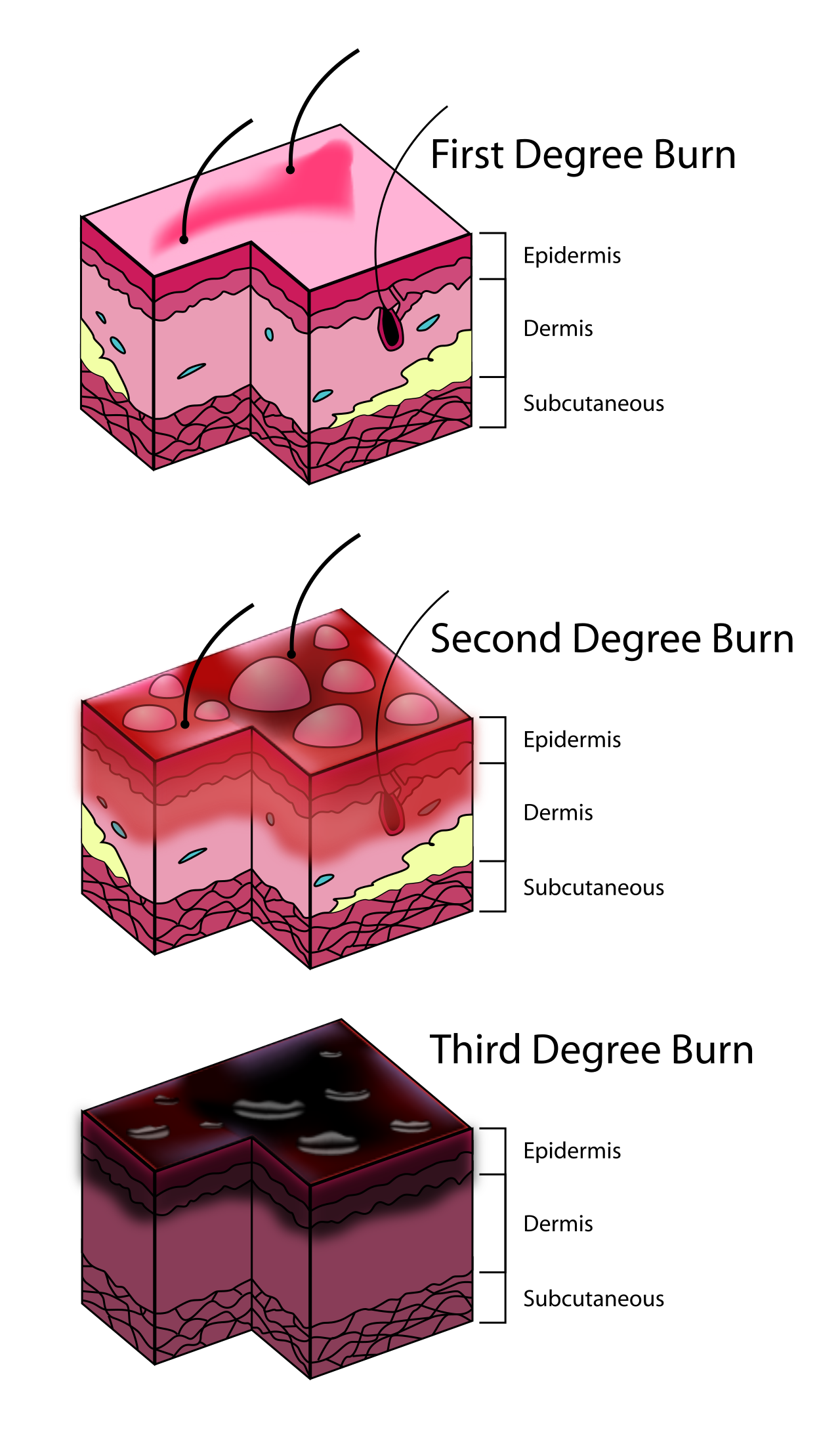 Burn depth: superficial (first degree), partial thickness (second degree) and full thickness (third degree).