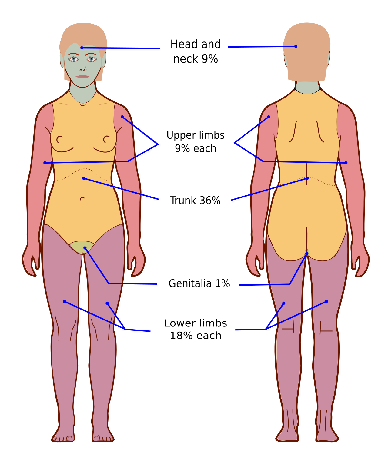 The rule of nines for estimating adult body surface area burned.